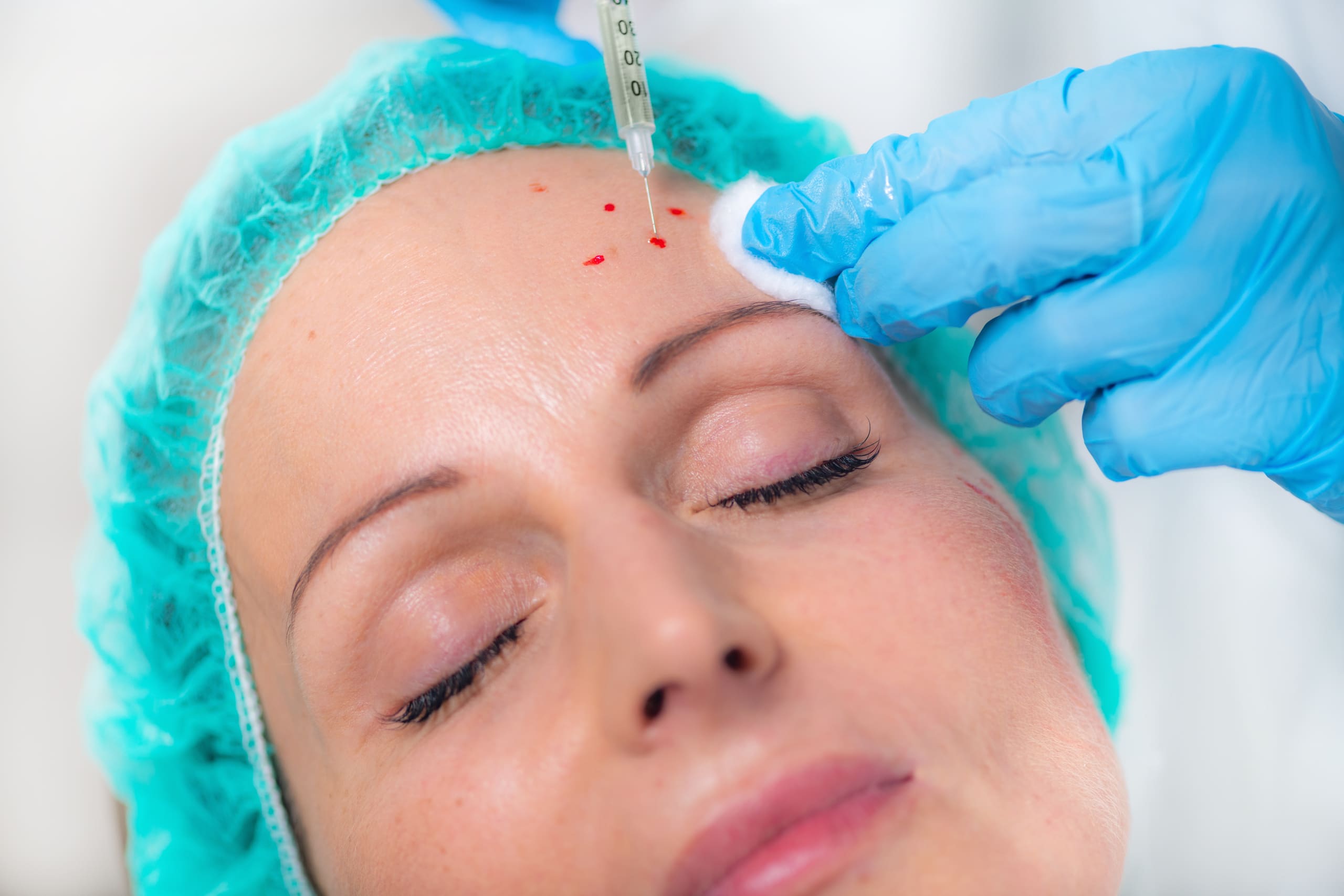 PRP treatments — illustrative image