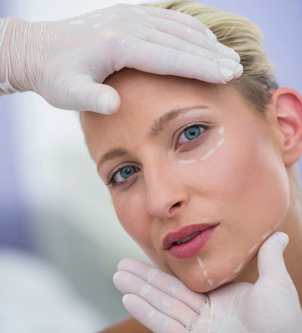woman face marked by plastic surgeon before facelift surgery